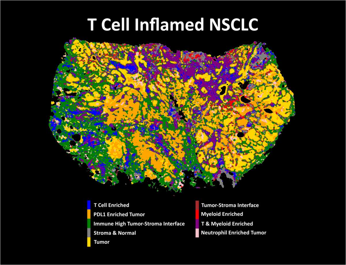 Overcoming the challenges of spatial biology with AI